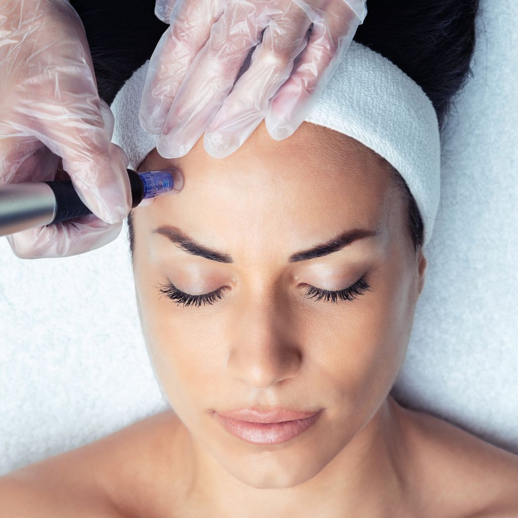 Microneedling mit ExosomenPDRN