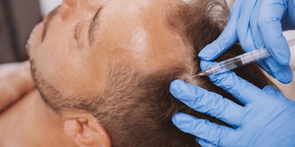 Close up of a mature man receiving hairloss treatment injections in scalp by professional trichologist. Dermatologist doing scalp injections for mature male client with alopecia problem